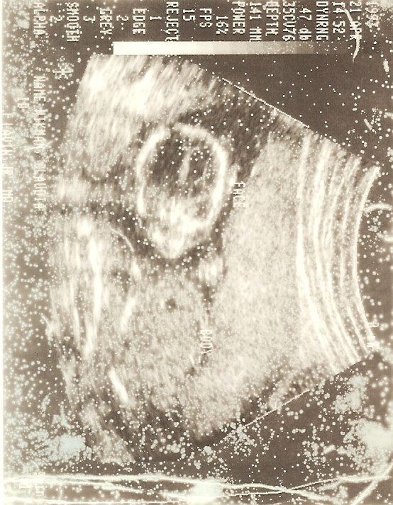 This ultrasound is taken five-six months before Jacob was born